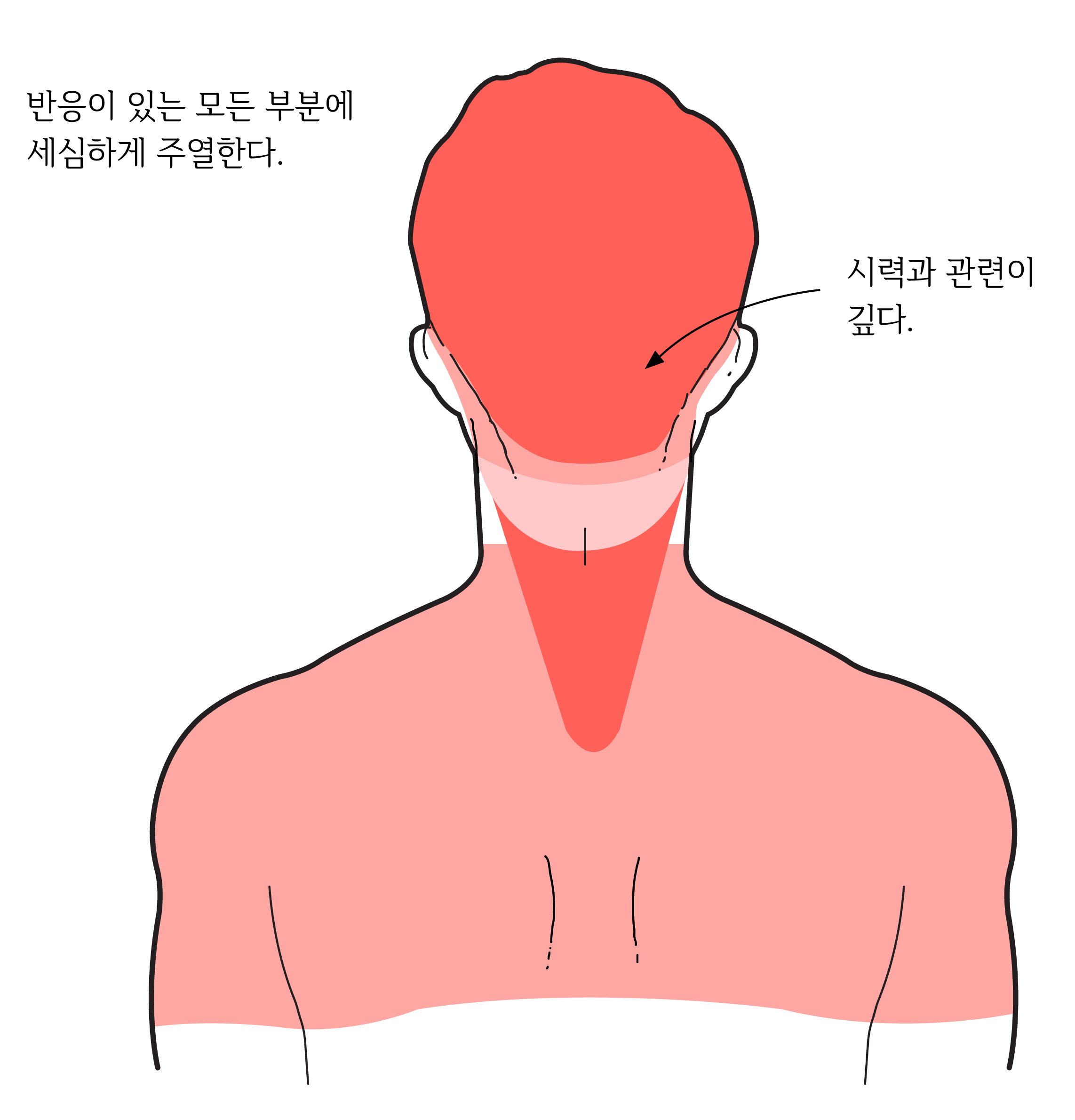 뇌종양