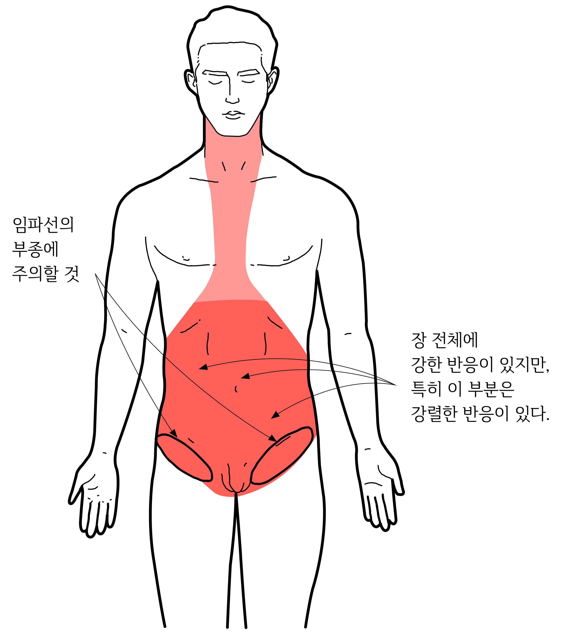 대장암